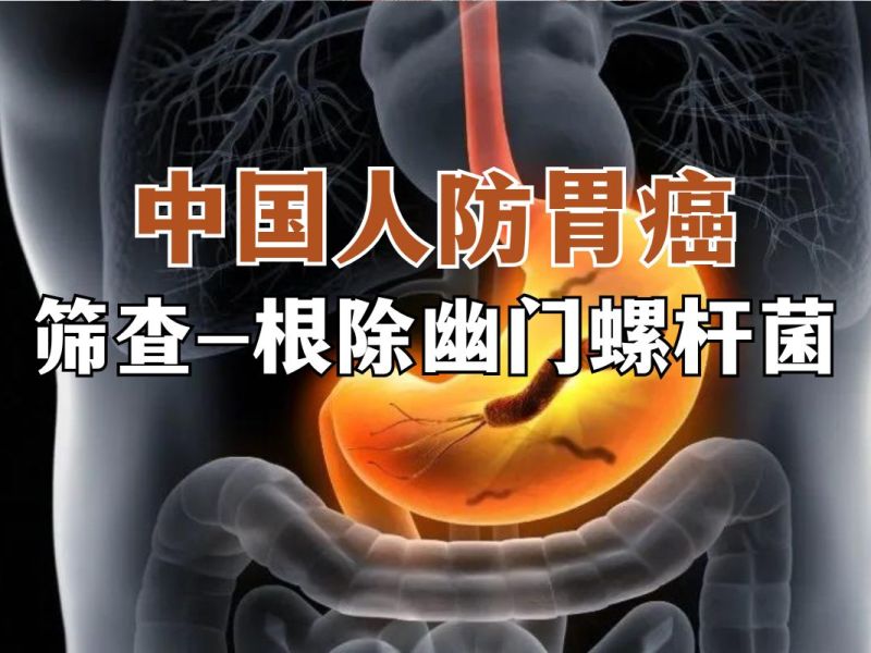 中国人防胃癌——筛查、根除幽门螺杆菌